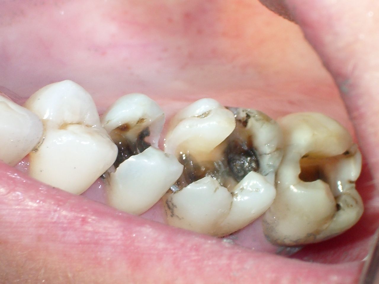 Khi nào thì nên đi chữa tủy răng?